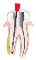 Root Canal File-678 Root Canal File-678